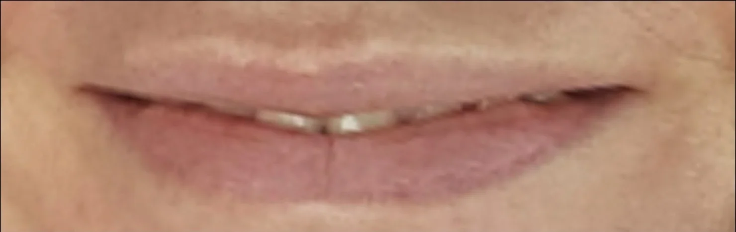 Permanent Make-up · Lippen – Vorher