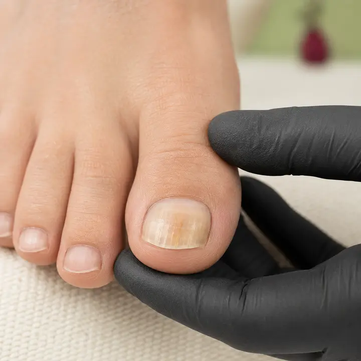 Nagelpilz