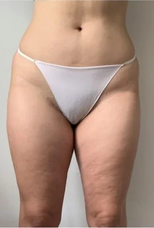 Volumen & Cellulite – Vorher