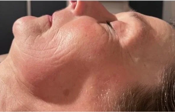 Anti-Aging & Konturen – Nachher
