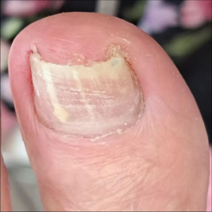 Nagelkorrektur mit Spange – Vorher