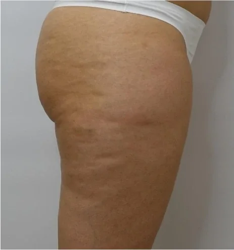 Cellulite – Vorher