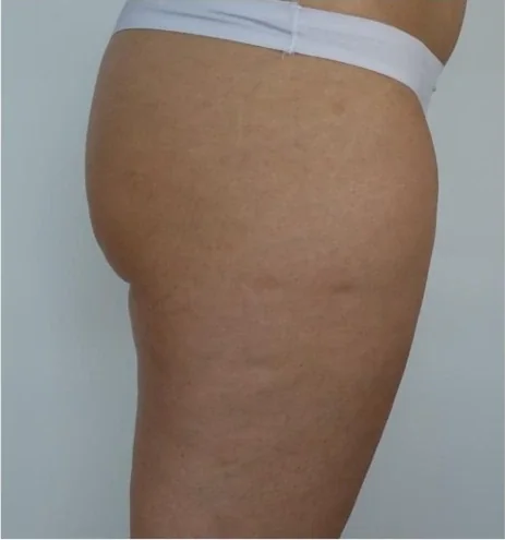 Cellulite – Nachher