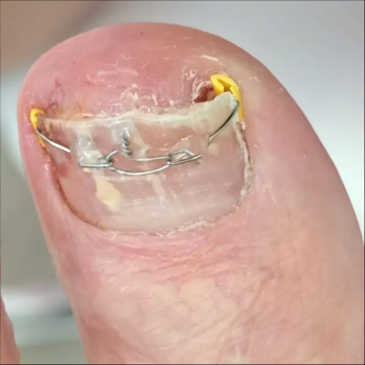Nagelkorrektur mit Spange – Nachher